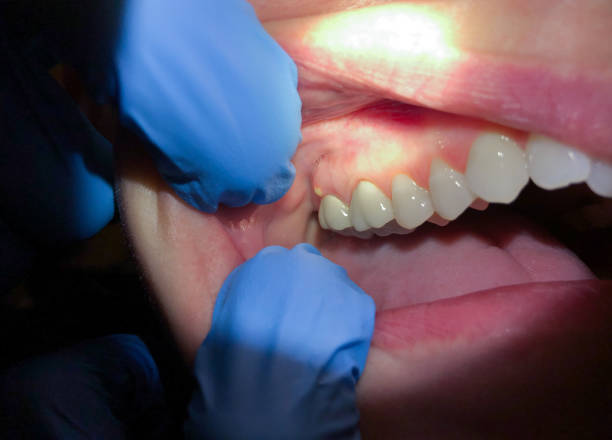 Best Emergency Dental Extractions in Bon Air, VA